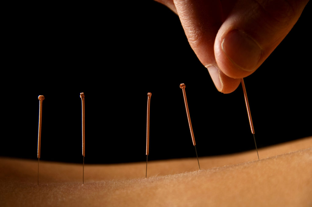 Spine Pain Acupuncture Treatment Santa Monica, CA